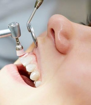 Снятие зубного камня